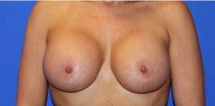 after breast augmentation front view case 1018