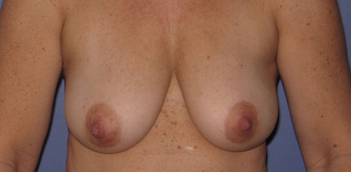 before breast augmentation front view case 1063