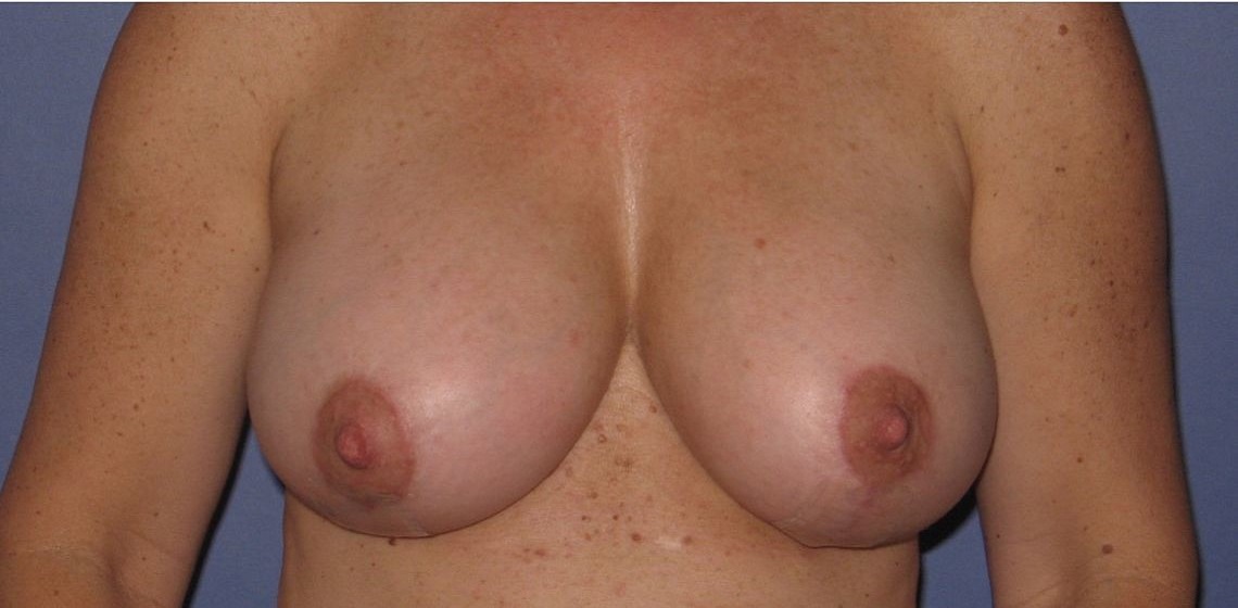 after breast augmentation front view case 1063