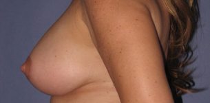 after breast augmentation side view case 1063