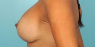 after breast augmentation side view case 1087