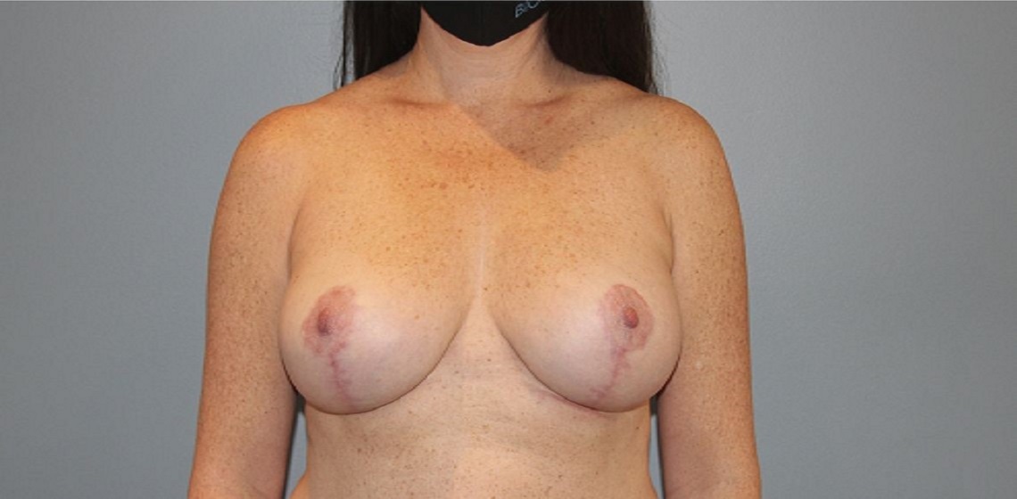 after breast augmentation front view case 1123