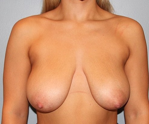 before breast augmentation front view case 1144