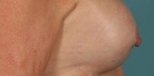 before breast implant revision side view case 852