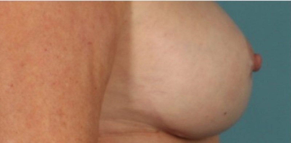 after breast implant revision side view case 852
