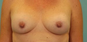 before breast implant revision front view case 865