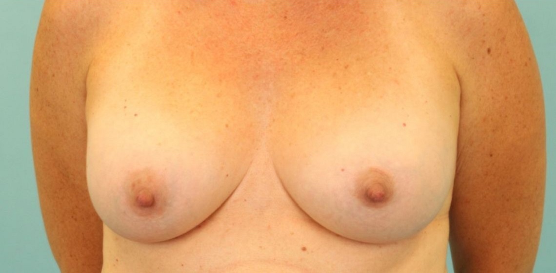 after breast implant revision front view case 865