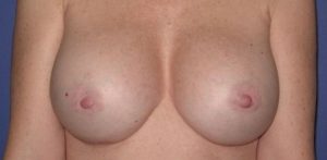 after breast implant revision front view case 880