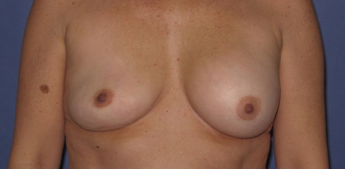 before breast implant revision front view case 890