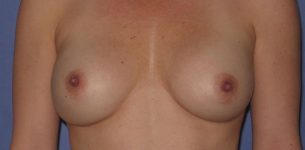 before breast implant revision front view case 909