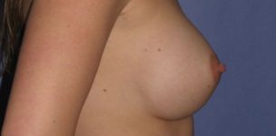 before breast implant revision side view case 909
