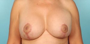 after breast implant revision front view case 922