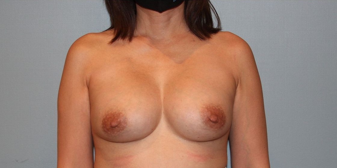 after breast implant revision front view case 935
