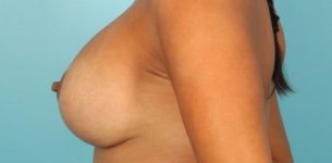 after breast augmentation side view case 944