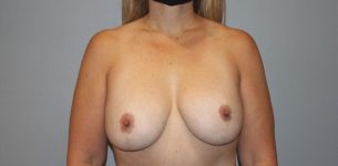before breast implant revision front case 958