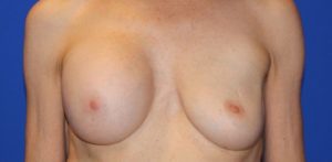 Patient Breast Lift Before 0