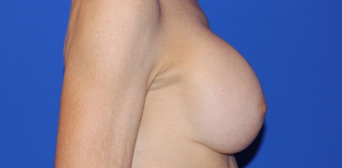 before breast lift right view of female patient 435 at Paydar Plastic Surgery
