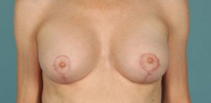 Patient Breast Lift After 0