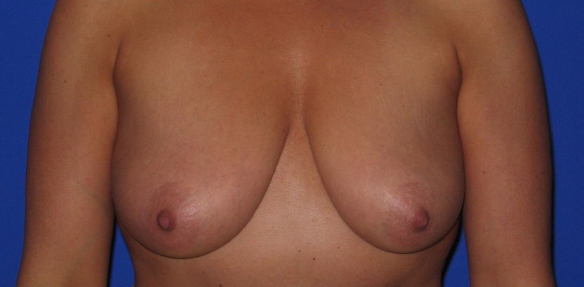 before breast lift front view of female patient 486 at Paydar Plastic Surgery