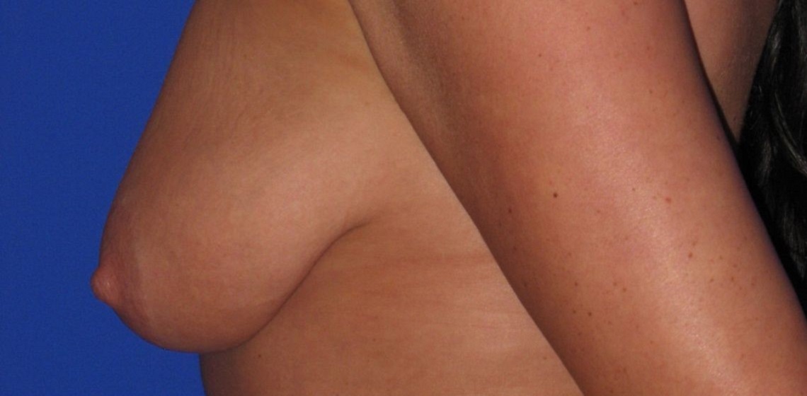 before breast lift left side view of female patient 486 at Paydar Plastic Surgery