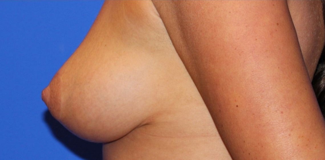after breast lift left side view of female patient 486 at Paydar Plastic Surgery
