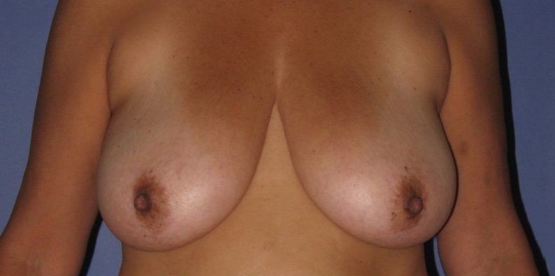 before breast lift front view of female patient 513 at Paydar Plastic Surgery