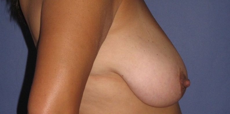 before breast lift right side view of female patient 513 at Paydar Plastic Surgery