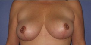 after breast lift front view of female patient 513 at Paydar Plastic Surgery