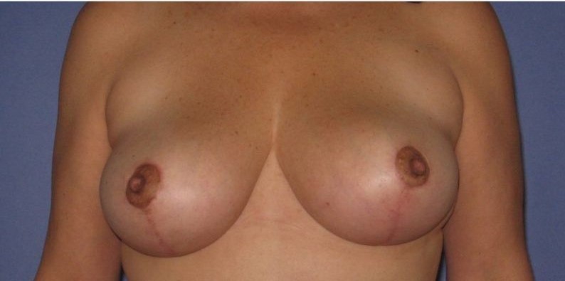 after breast lift front view of female patient 513 at Paydar Plastic Surgery