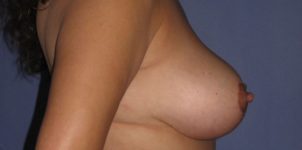 after breast lift right side view of female patient 513 at Paydar Plastic Surgery