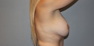 before breast lift right side view of female patient 564 at Paydar Plastic Surgery