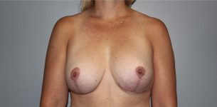 after breast lift front view of female patient 564 at Paydar Plastic Surgery