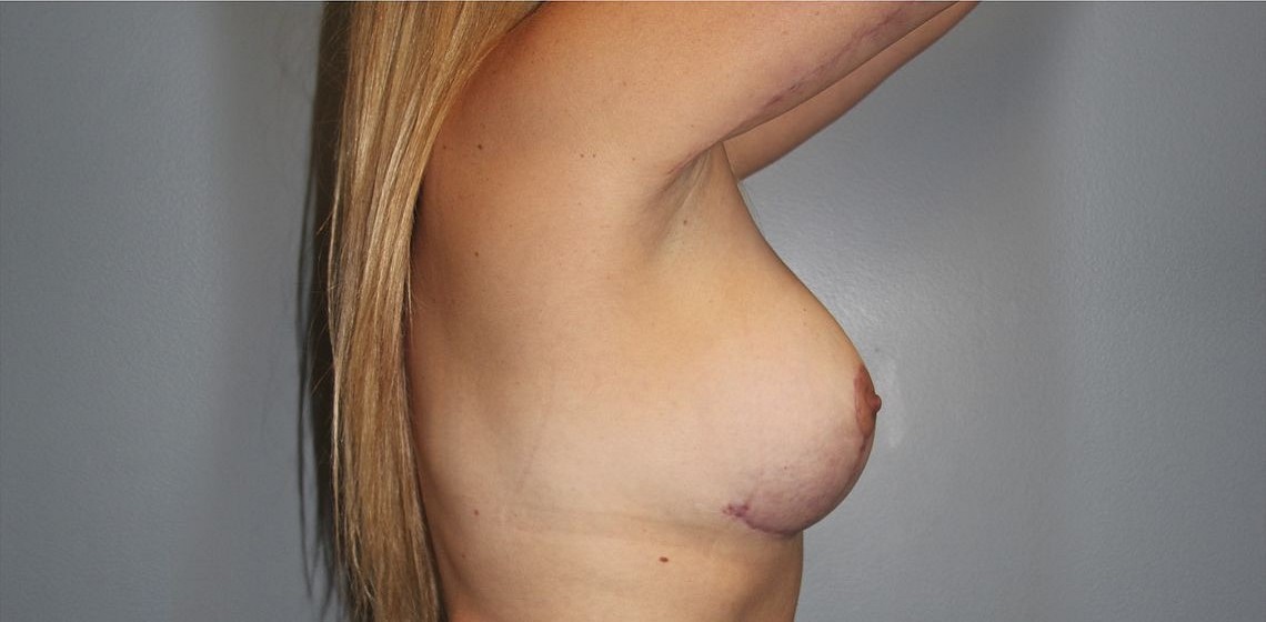 after breast lift right side view of female patient 564 at Paydar Plastic Surgery