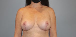 after breast lift front view of female patient 571 at Paydar Plastic Surgery