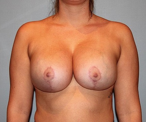 after breast lift front view of female patient 579 at Paydar Plastic Surgery