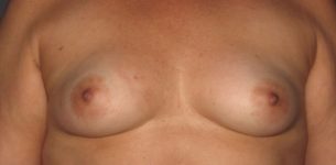 before breast reconstruction front view of female patient 702 at Paydar Plastic Surgery