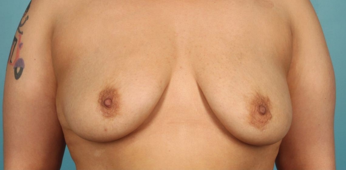 before breast reconstruction front view of female patient 716 at Paydar Plastic Surgery