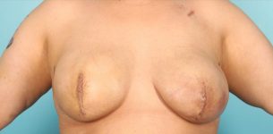 after breast reconstruction front view of female patient 716 at Paydar Plastic Surgery