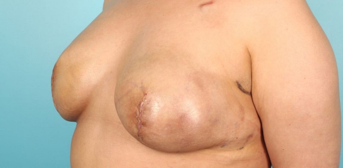 after breast reconstruction left angle view of female patient 716 at Paydar Plastic Surgery