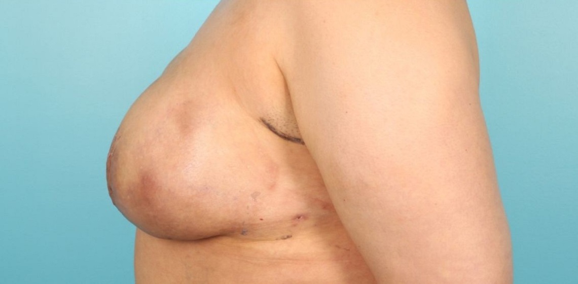 after breast reconstruction left view of female patient 716 at Paydar Plastic Surgery