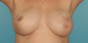 after breast reconstruction front view of female patient 725 at Paydar Plastic Surgery