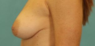 before breast reconstruction left view of female patient 739 at Paydar Plastic Surgery