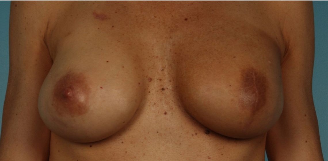 after breast reconstruction front view of female patient 739 at Paydar Plastic Surgery