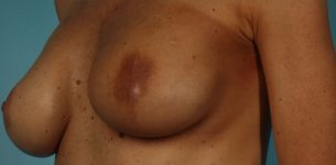 after breast reconstruction left angle view of female patient 739 at Paydar Plastic Surgery