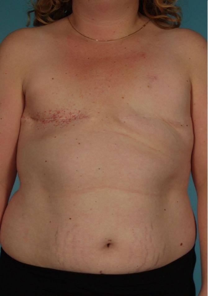 before breast reconstruction front view of female patient 754 at Paydar Plastic Surgery