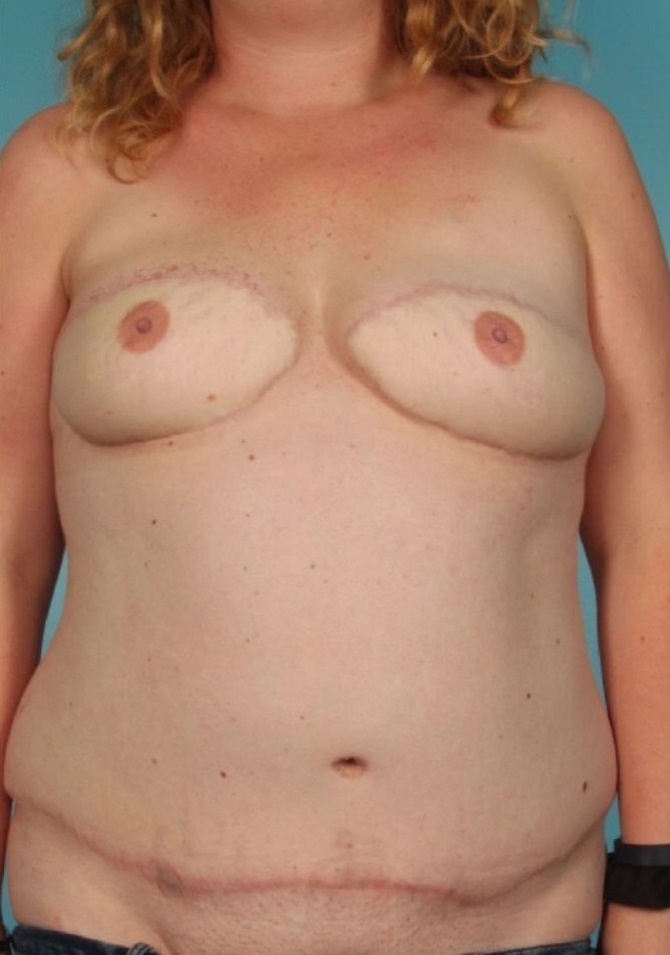 after breast reconstruction front view of female patient 754 at Paydar Plastic Surgery