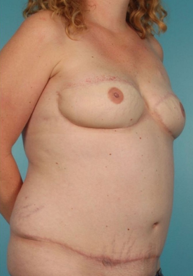 after breast reconstruction right angle view of female patient 754 at Paydar Plastic Surgery