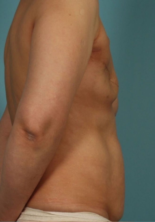 before breast reconstruction side view case 769