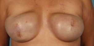 before breast reconstruction front view case 790