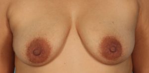 before breast reconstruction front view case 805